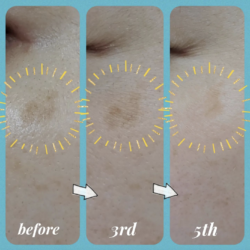 回数重ねた結果、長年悩んでいた頬のシミが薄くなりました🎵オリジナルブレンドのエッセンスで✨