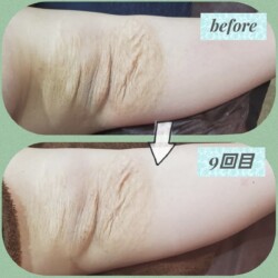 高濃度のエッセンスをお一人お一人に合わせて
オリジナルブレンド。脇の皮膚伸展線症や線状皮膚萎縮症、「肉割れ」にもCoeur a Coeurのオリジナルエッセンスで、ここまでの改善ができました🎵